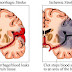 Mengenal Lebih Jauh Tentang Stroke