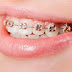 Niềng răng lệch lạc là gì