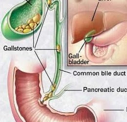 Who are the symptoms of gall stones