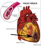 <Img src ="Dibujo-corazón-con-infarto.jpg" width = "220" height "250" border = "0" alt = "Imagen de Infarto cardíaco">