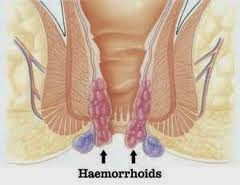 Gejala Penyakit Wasir Atau Ambeien