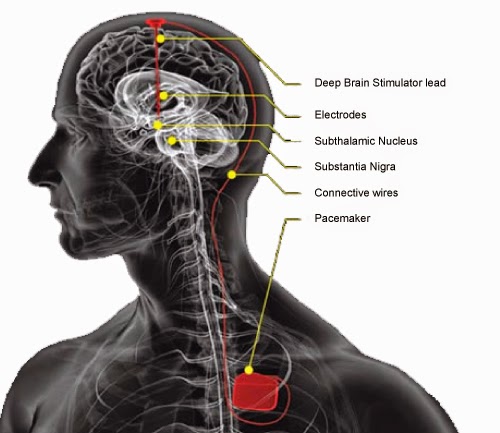 http://www.neurosurgerynow.com/parkinsons-syndrome.php