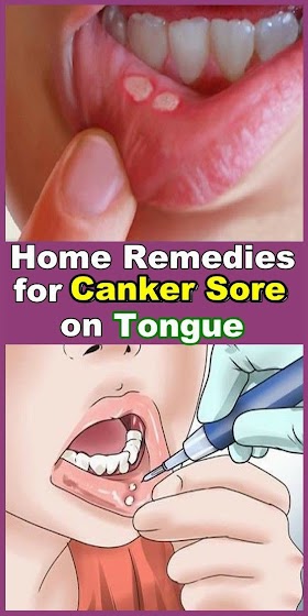 Home Remedies for Canker Sores on Tongue