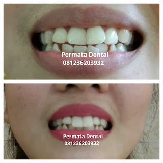 gambar foto contoh veneer gigi kelinci buatan manis cantik bali jember banyuwangi murah berkualitas di PERMATA DENTAL gambar gigi rusak yang di veneer gigi yang tidak rapi gigi renggang gigi patah cuil rompal pendek karies hitam kuning