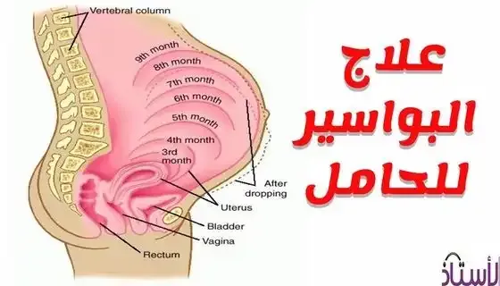 How-to-reduce-the-chances-of-hemorrhoids-during-pregnancy