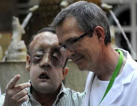 Transplantasi Wajah Yang Dilakukan Pria Ini Benar-benar Rusak [ www.BlogApaAja.com ]