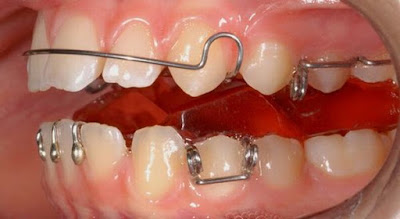 Các cách chỉnh răng mọc không đều hiệu quả? 