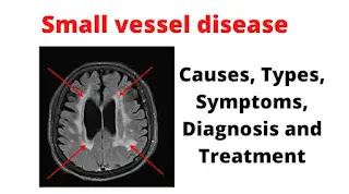 What IIs Small Vessel Disease(CSVD)