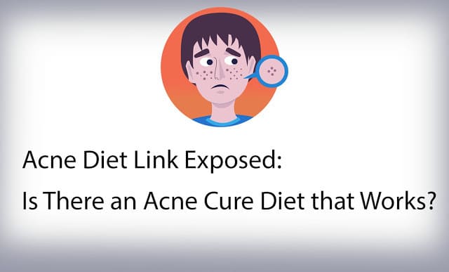 Acne Diet Link Exposed: Is There an Acne Cure Diet that Works?