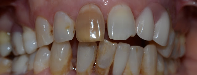 Before Treatment of Discolored Nonvital Central Incisor Tooth