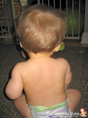 Baby with slight right torticollis and minor trunk tilt