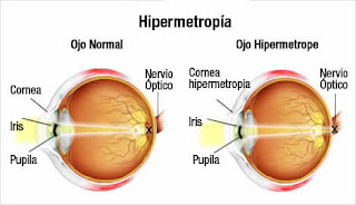 miopia e astigmatismo, o que e astigmatismo, astigmatismo e miopia juntos, astigmatismo e miopia tem cura, hipermetropia e astigmatismo juntos, astigmatismo miópico, miopia o que é, astigmatismo sintomas, astigmatismo infantil