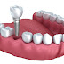 Cấy ghép răng implant ở đâu tốt nhất Hà Nội?