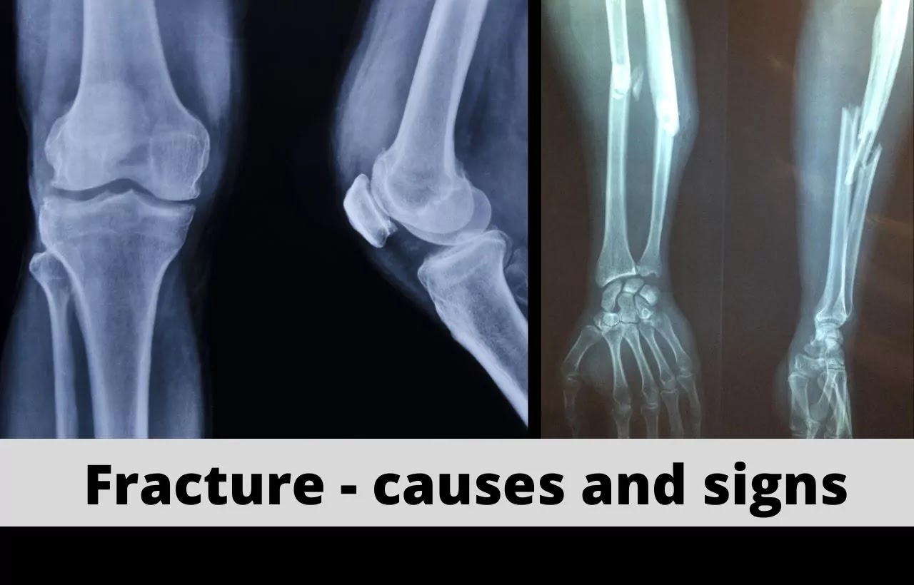 Fracture: Causes and signs