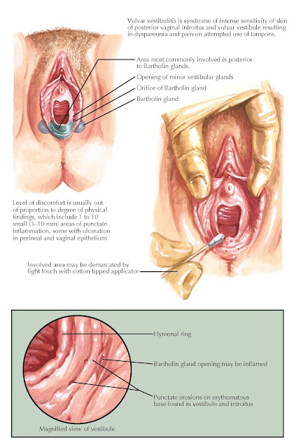 VULVAR VESTIBULITIS