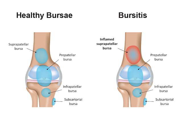 Obat tradisional bursitis