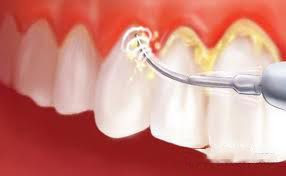 Răng ố vàng nên tẩy trắng hay lấy cao răng?