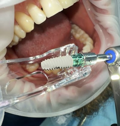 Имплантация – новейшая технология восстановления зубов в Москве