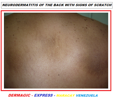 Neurodermatitis of the back