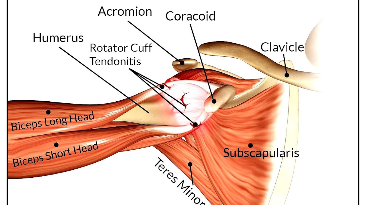 What To Do For A Rotator Cuff Injury