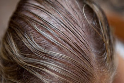 Nguyên nhân cụ thể nào dẫn tới mất tóc