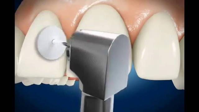 Trám răng cửa sẽ khôi phục được cả giá trị về chức năng cũng như giá trị thẩm mỹ của cả hàm răng