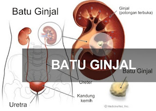 Penyakit Batu Ginjal