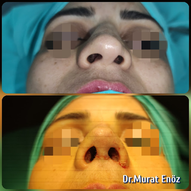 Micromotor Assisted Revision Nose Aesthetic Surgery, Complicated Revision Rhinoplasty, Open roof deformity,Nasal valve collapse,Crooked nose,