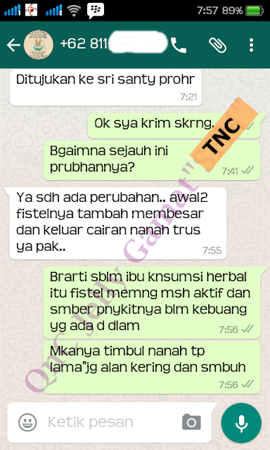 Obat Fistula Ani