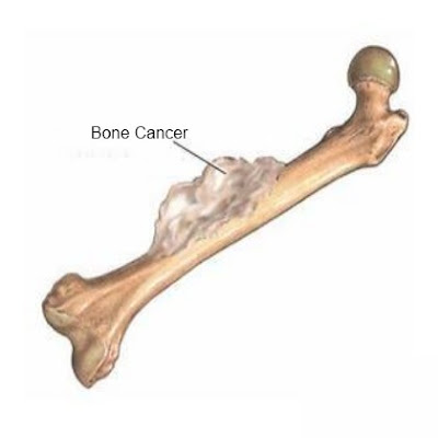 Ung thư xương và quá trình di căn xương
