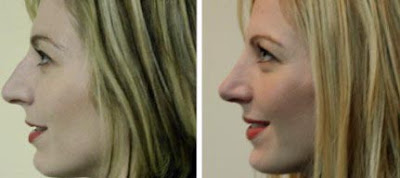 Rhinoplasty Pics