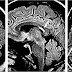 Neuroborreliosis