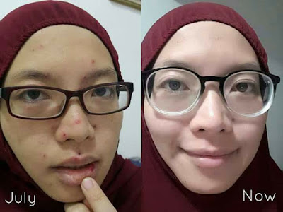 Testimoni Kulit Berseri Dan Anjal Dengan Produk Shaklee