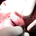 Eye Lid Surgery in Bangalore