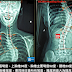 脊椎側彎矯正案例15 - 治療16次/ 胸椎側彎52度改善到42.5度