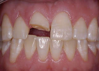 răng bị mẻ phải làm thế nào để khắc phục?