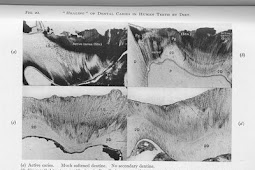 Images of Tooth Decay Healing due to an Improved Diet