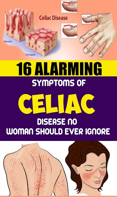 16 Alarming Symptoms of Celiac Disease No Woman Should Ever Ignore