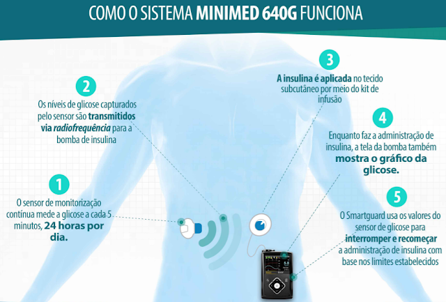 bomba de infusão, bomba de insulina, minimed 640G, medtronic, diabetes