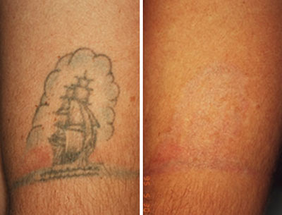 Many people discover Laser Tattoo Removal remedy gives the very best results 