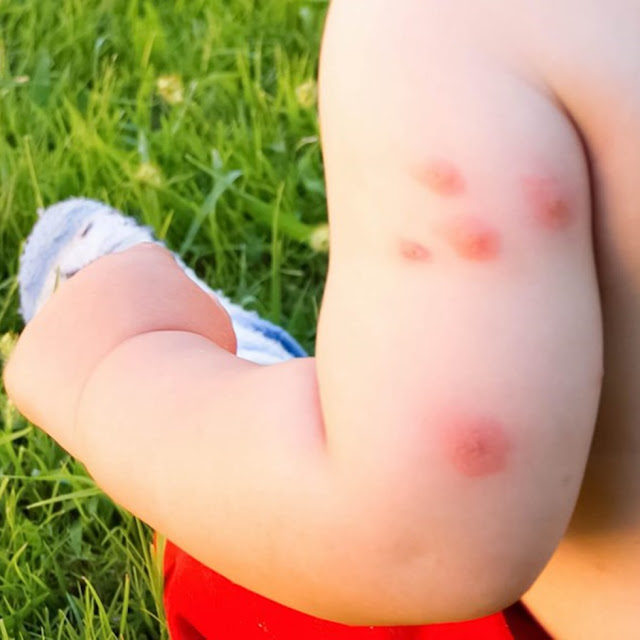 cara menghalau nyamuk dari terus menggigit bayi kecil anda, bayi merengek digigit nyamuk, tips hilangkan kesan gigitan nyamuk, bugs away, bugs away tasneem naturel, agent sah tasneem naturel, elakkan diri daripada nyamuk, insect repellent, tips elak digigit nyamuk, lavender halau nyamuk, kulit limau halau nyamuk, spray halau nyamuk, cara halau nyamuk dalam kereta, cara hindari nyamuk, limau dan cengkeh halau nyamuk, menyembut ubat nyamuk, anak kena gigit nyamuk, anak selalu kena gigit nyamuk, anak digigit nyamuk, bayi di gigit nyamuk, bintat nyamuk, bintat di muka, bintat pada bayi, bintat di badan, gigitan nyamuk, guna tiger balm untuk elak kena gigit nyamuk, mosquito repellent, tiger balm, tiger balm mosquito repellent, petua elak di gigit nyamuk, tips elak anak digigit nyamuk