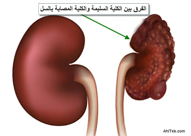 السل في الكلية - الدرن الكلوي