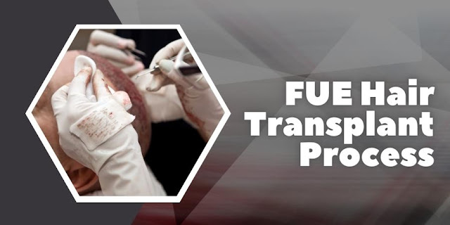 FUE Hair Transplant Process