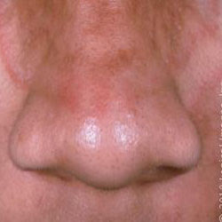 Nasal Yeast infection