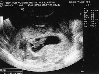 ultrasounds at 8 weeks. ultrasounds at 8 weeks. from