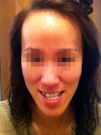 짱이뻐! - This Is Why I Decided To Do Two Jaw Plastic Surgery in Korea