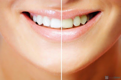 Một số cách làm sạch răng phổ biến