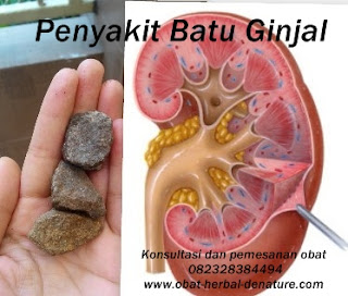 cara menghancurkan batu ginjal tanpa operasi,obat batu ginjal,obat kencing batu,cara mengeluarkan batu ginjal tanpa operasi,cara menghilangkan batu ginjal tanpa operasi