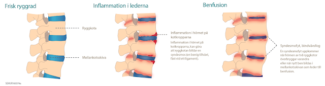 Bilden är lånad från: http://reumatikerlinjen.se/wp-content/uploads/2016/08/bodymap-as-new.png