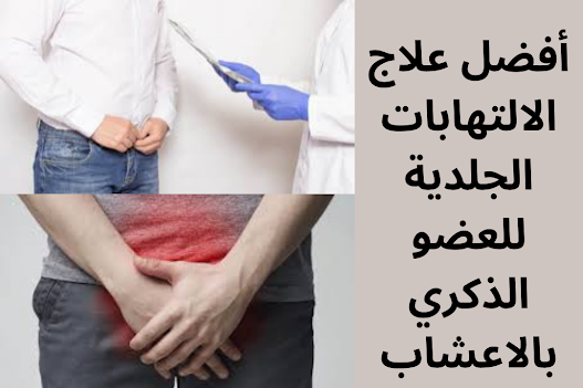 أفضل علاج  الالتهابات الجلدية للعضو الذكري بالاعشاب